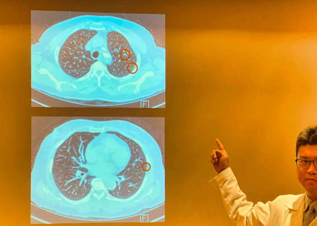 毛玻璃結節治療